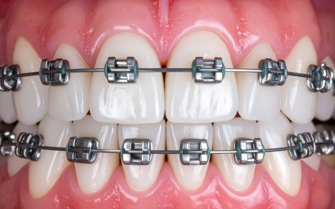 What to Expect With Braces