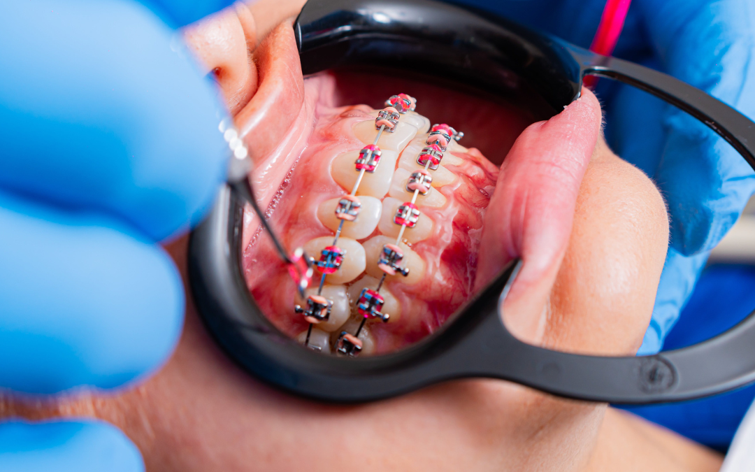 Choosing an Orthodontist for Braces