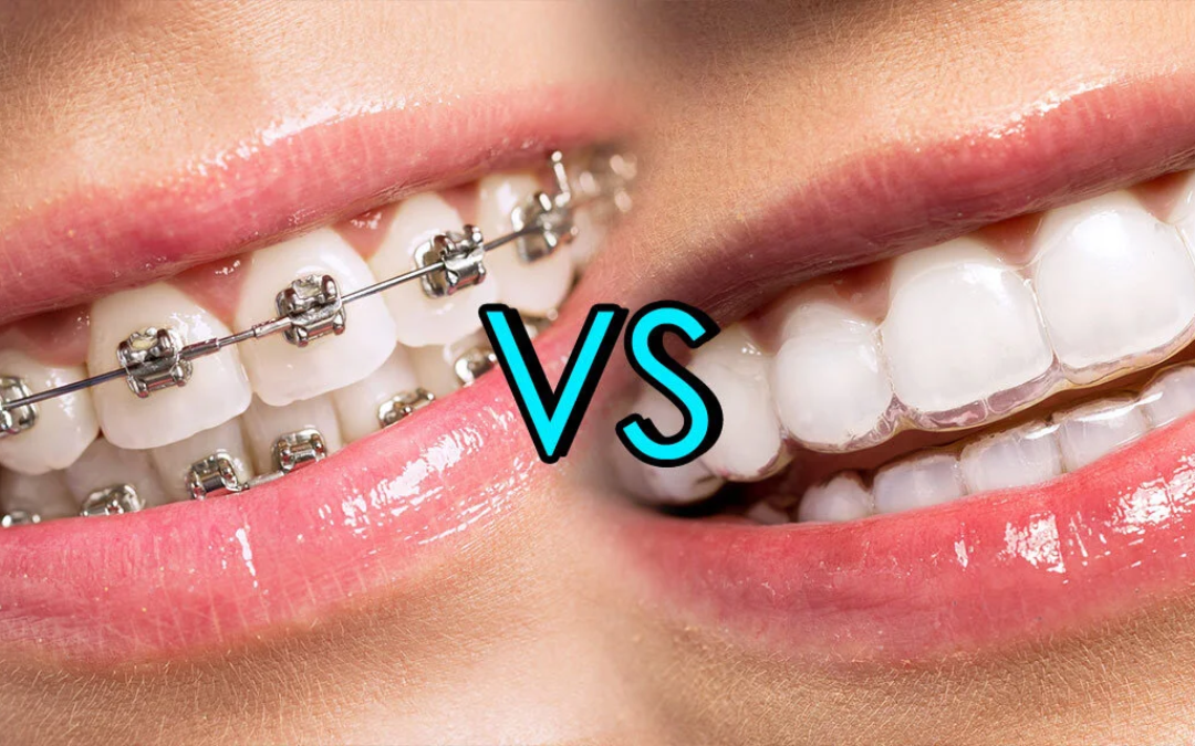 Invisalign vs Braces: Which Orthodontic Treatment Is Right for You?