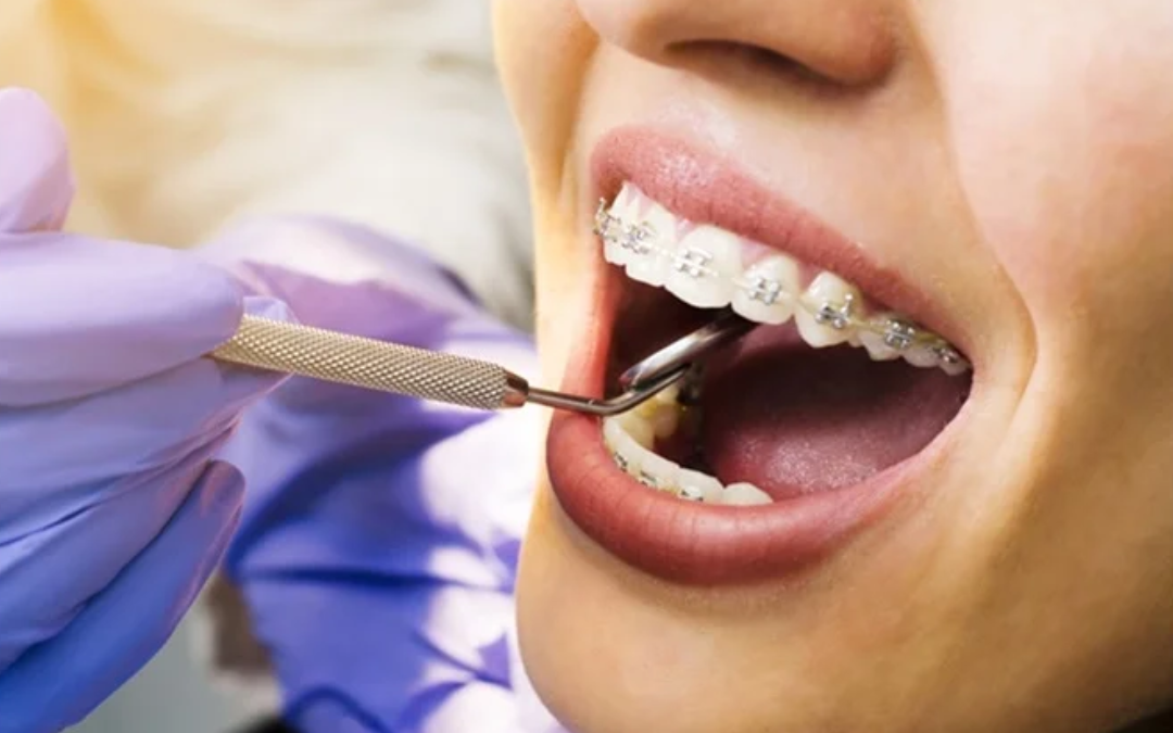 What to Expect With Braces: A Complete Step-by-Step Guide to Orthodontic Treatment