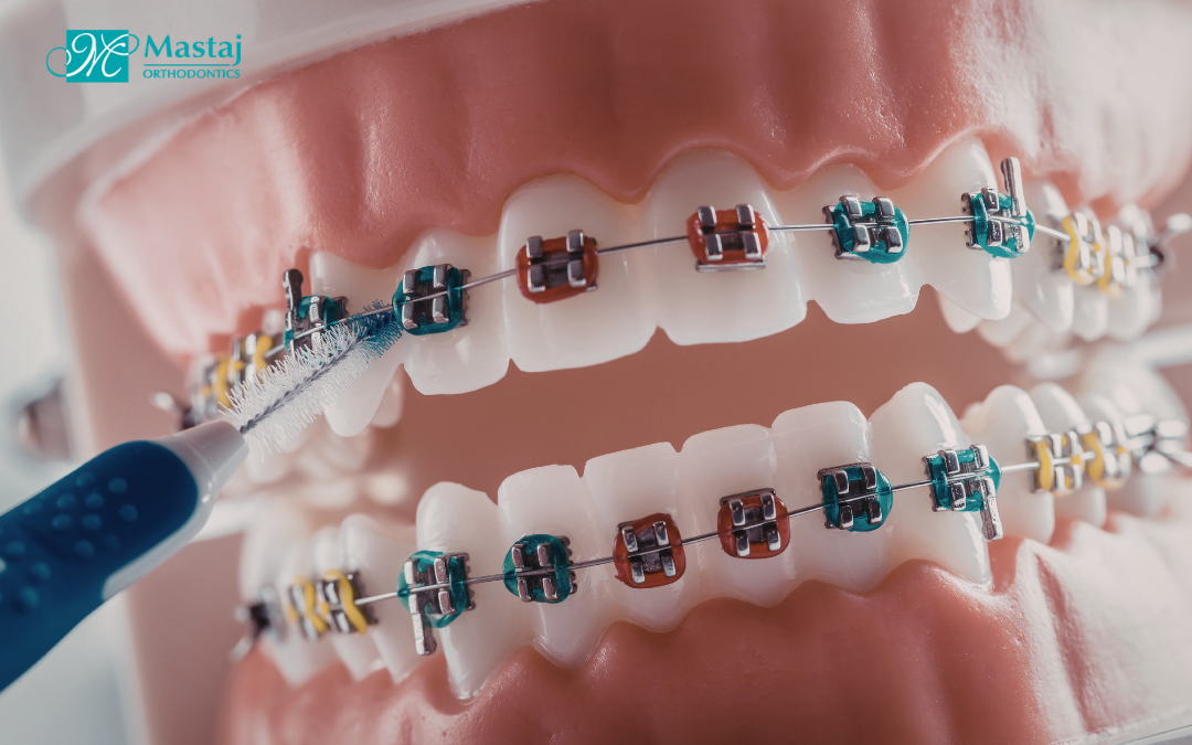 Braces in Bryn Mawr, PA: Everything You Need to Know Before Starting Treatment