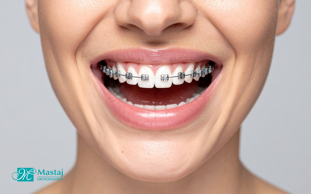 Finding the Best Orthodontist in Bryn Mawr, PA: What to Look for and Why It Matters