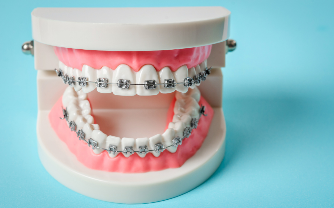 Smile Emergencies: What to Do When Braces Break, Aligners Go Missing, or Retainers Stop Fitting